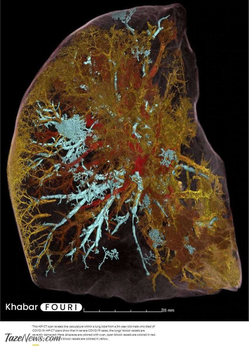 ریه یک مرد فوت شده بر اثر کرونا